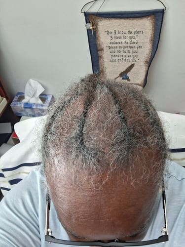Reviewer shows their head from above, with significant balding and thinning hair, as they use Rennora Hair Growth Serum.