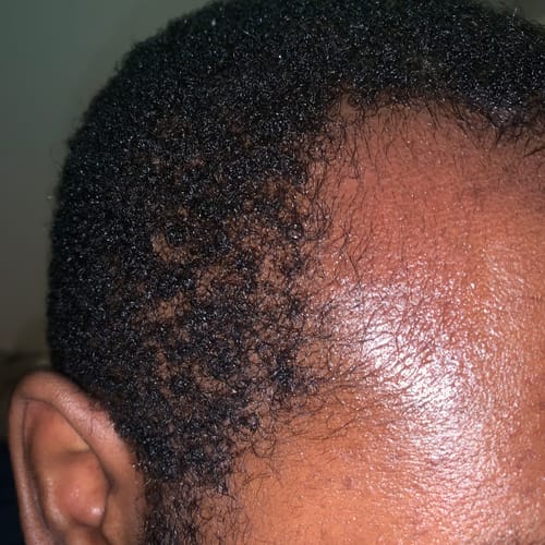 Customer photo review of Minoxidil+finasteride Solution - MEN ONLY, 3x60ml pack