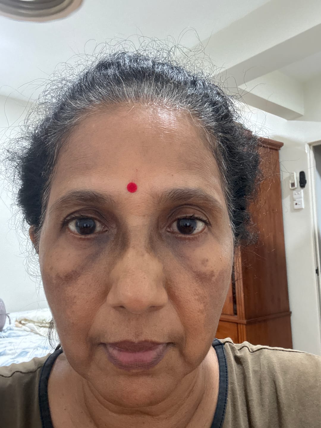 Customer photo review of Ventamin Light Up: Doctor-Formulated Brightening Formula for Melasma, Acne scars & Hyperpigmentation