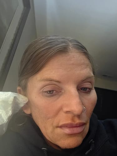 Reviewer's face showing the effect of the Seranova Micro Infusion System on fine lines and lips.