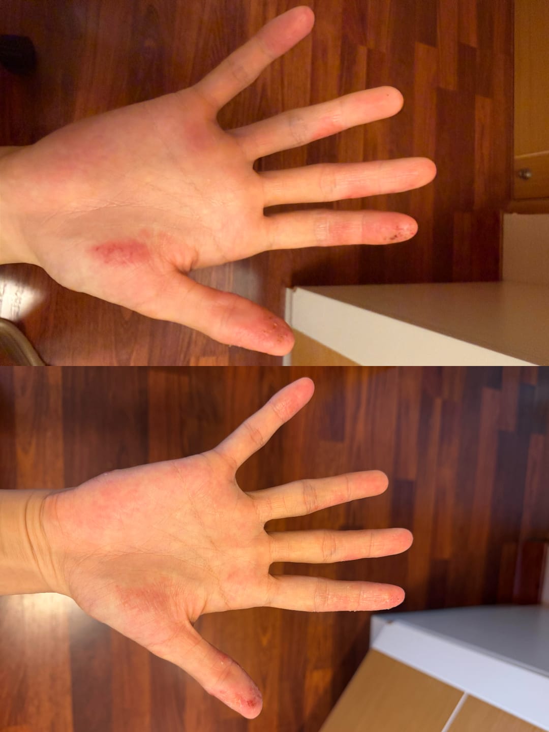 Customer photo review of Eczema Scratch Mitten