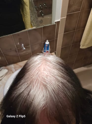 A reviewer's scalp viewed from above, showing white hair growth at the roots.