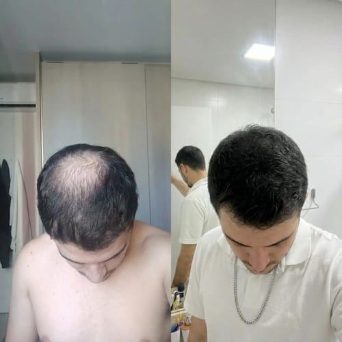 Customer photo review of RootFix - ערכה לטיפול בנשירה והתקרחות של השיער