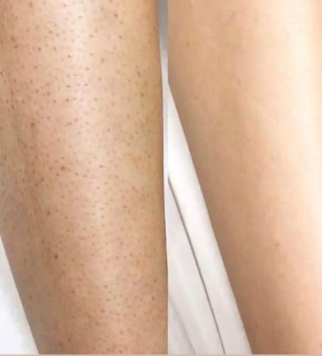 Customer photo review of Depilo IPL Max - Dauerhafte Haarentfernung
