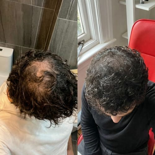 Customer photo review of RootFix - ערכה לטיפול בנשירה והתקרחות של השיער