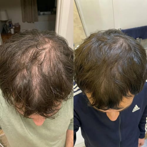 Customer photo review of RootFix - ערכה לטיפול בנשירה והתקרחות של השיער