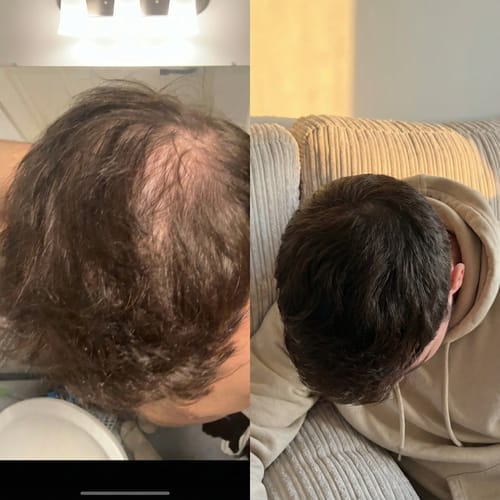 Customer photo review of RootFix - ערכה לטיפול בנשירה והתקרחות של השיער