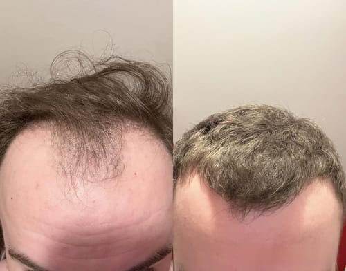 Customer photo review of RootFix - ערכה לטיפול בנשירה והתקרחות של השיער