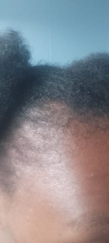 Customer photo review of Minoxidil 5% SOLUTION, 3x60ml pack