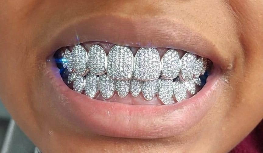 Customer photo review of 8 on 8 VVS Moissanite Diamond Grillz