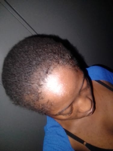 Customer photo review of Minoxidil High Strength (5%) SOLUTION, 3x60ml pack