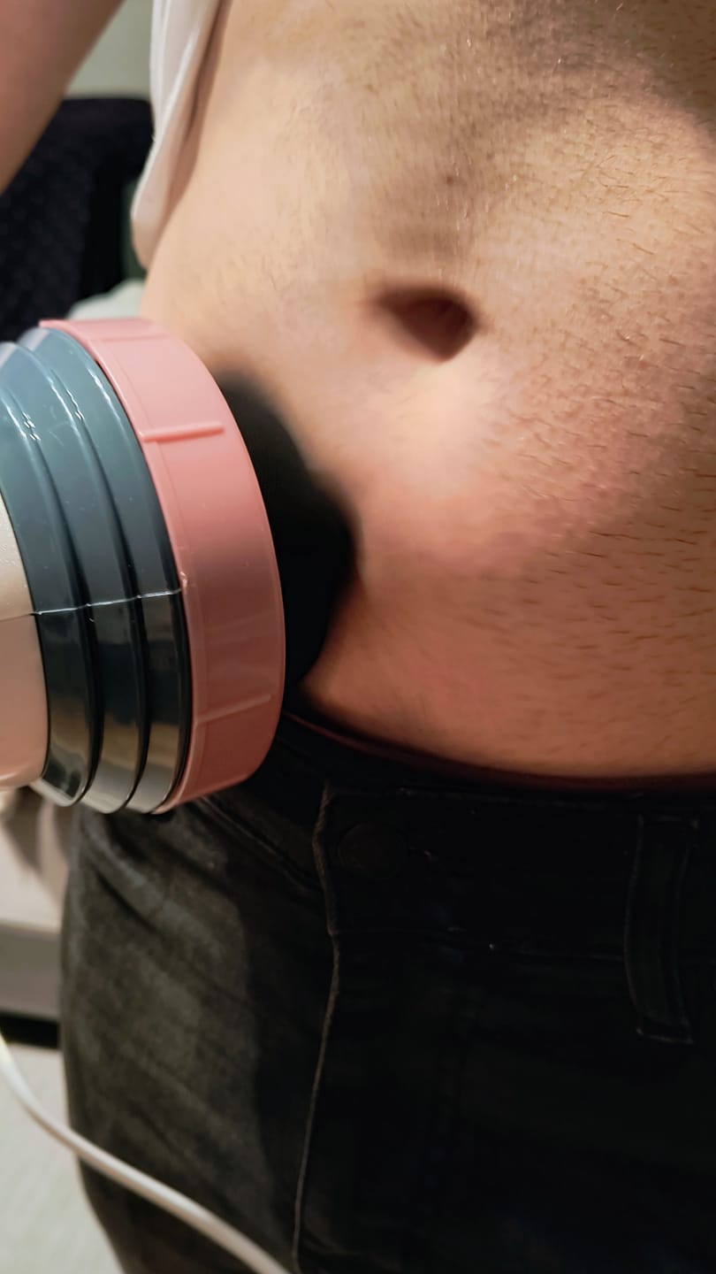 Customer photo review of Masajeador anticelulítico Cellu Clear Pro