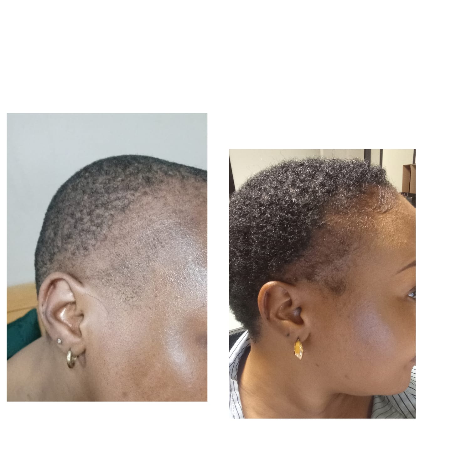 Customer photo review of Minoxidil REGULAR (2%) strength SOLUTION, 1 x 60ml pack