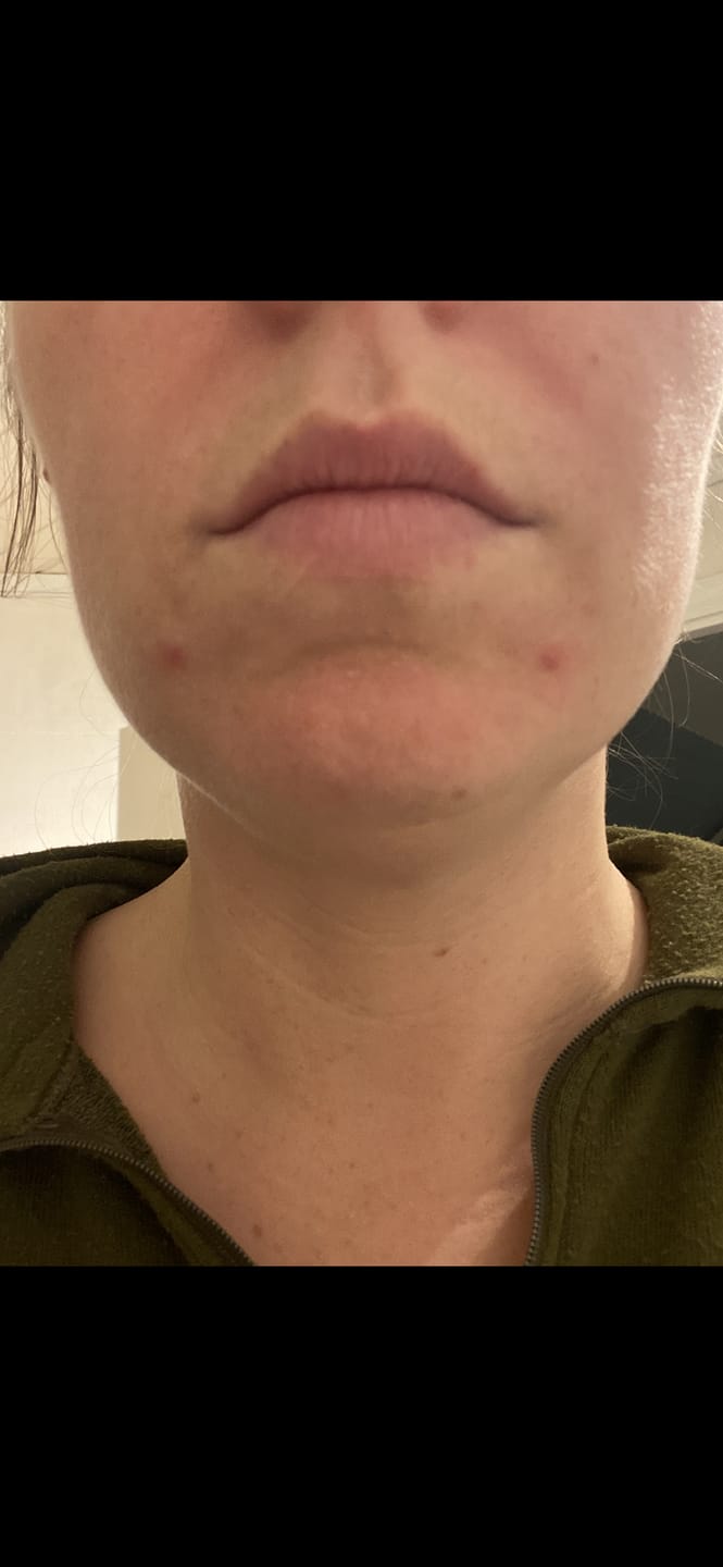 Kundenfotorezension zu Sanddorn und Brennnessel für die Gesichtspflege