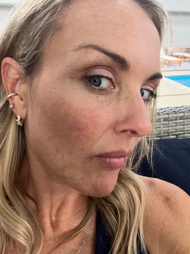 Customer's face after using The Micro Infusion System, showing improved skin texture and reduced redness.