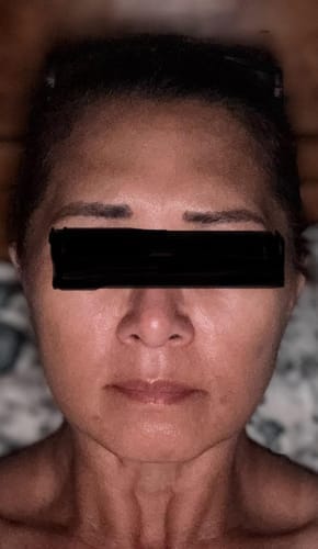 Customer photo review of Kojic Acid Turmeric Night Wrapping Mask