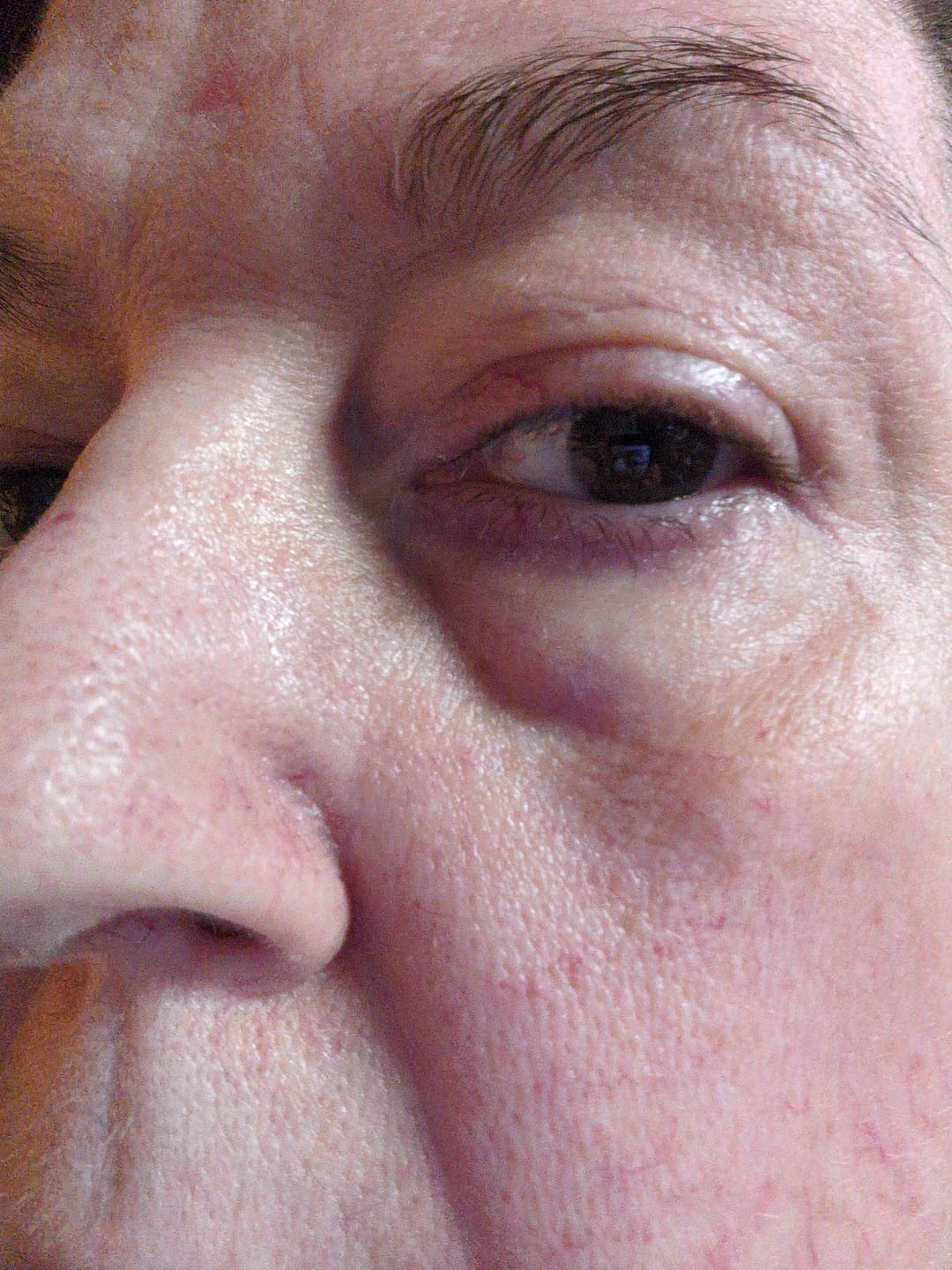 Customer photo review of Hyper Potent Dark Circles & Bag Eye Balm
