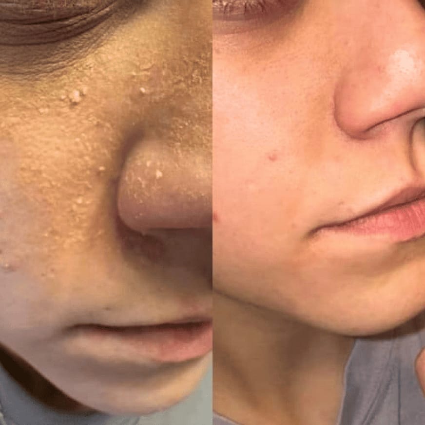 Customer photo review of Zilen Turmeric & Kojic Acid Night Wrapping Mask (75 ml)