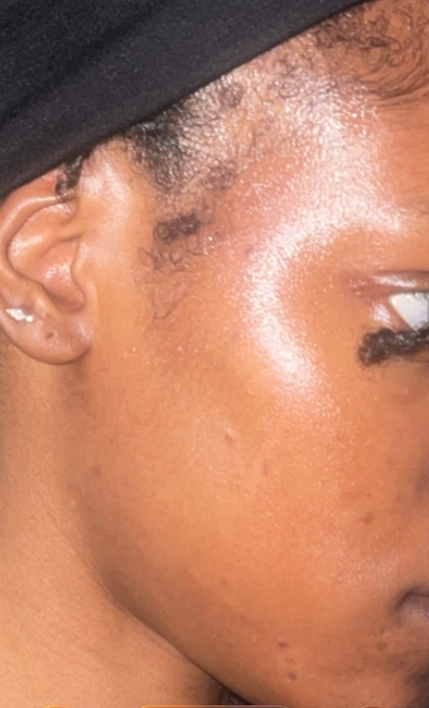 Customer photo review of Exfoliating Body & Face Bar – 3% Salicylic Acid + 10% Sulphur Soap