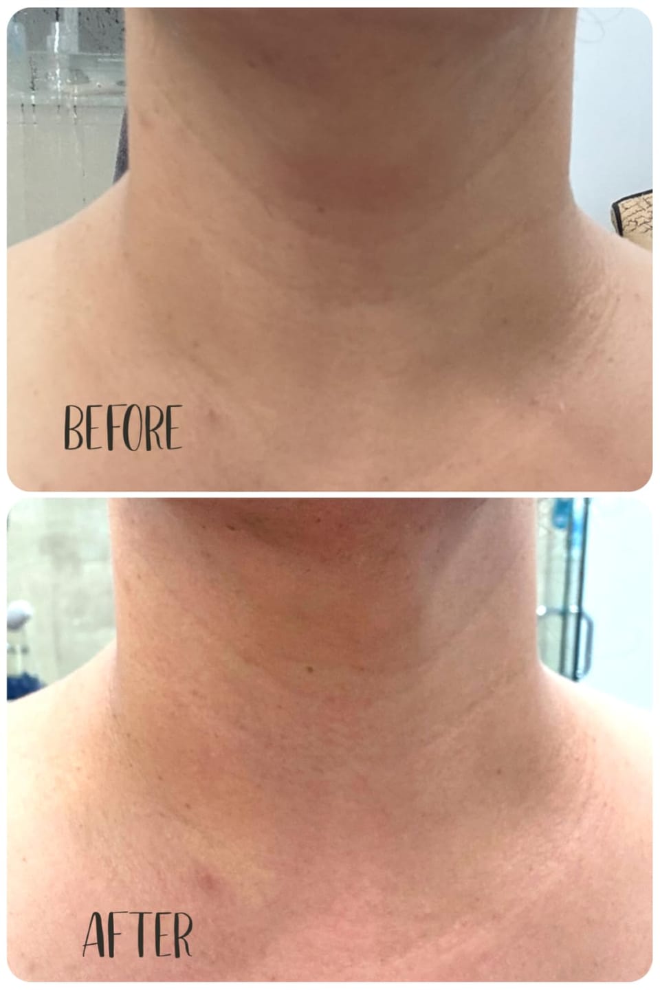 Customer photo review of Koriderm™ Time Reverse Neck Cream