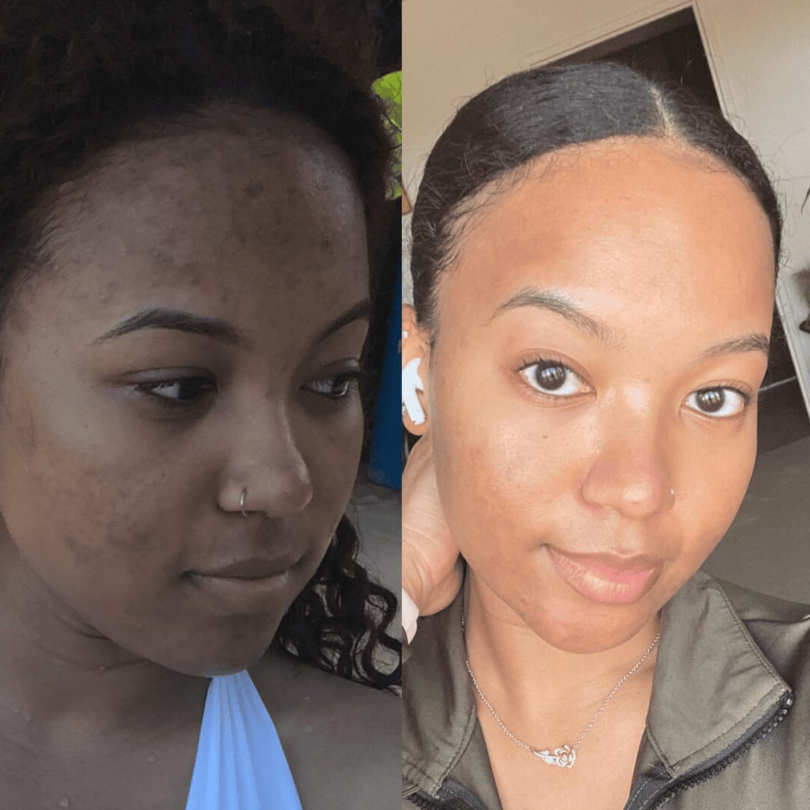 Customer photo review of Zilen Turmeric & Kojic Acid Night Wrapping Mask (75 ml)