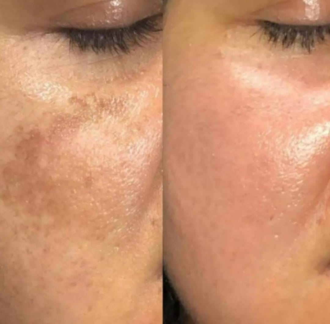 Customer photo review of Tónico Anti-Imperfecciones
