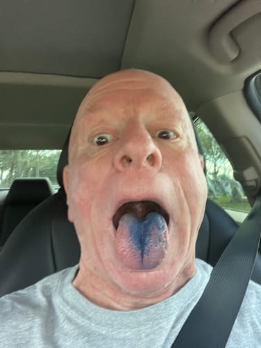 Customer shows a blue tongue after taking the Just Blue™ methylene blue troches.