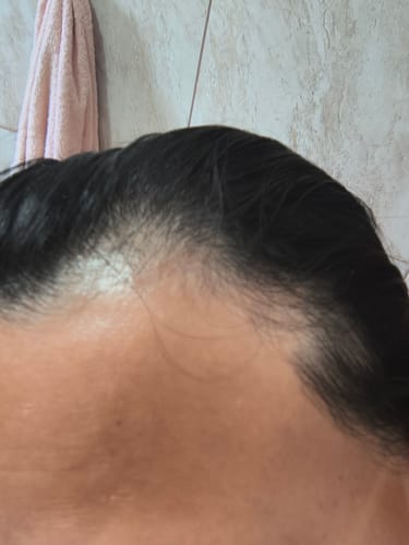 Close-up do cabelo de uma cliente com falhas na linha do cabelo antes de usar o suplemento Happy Hair.