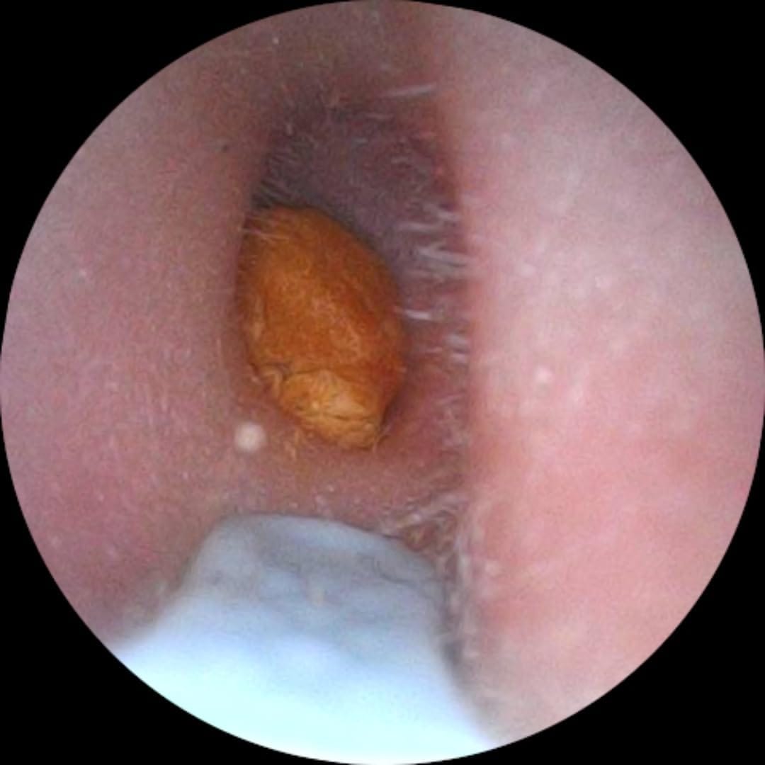 Customer photo review of Earclean - Doktor Onaylı 1080P Kulak Temizlik Kamerası