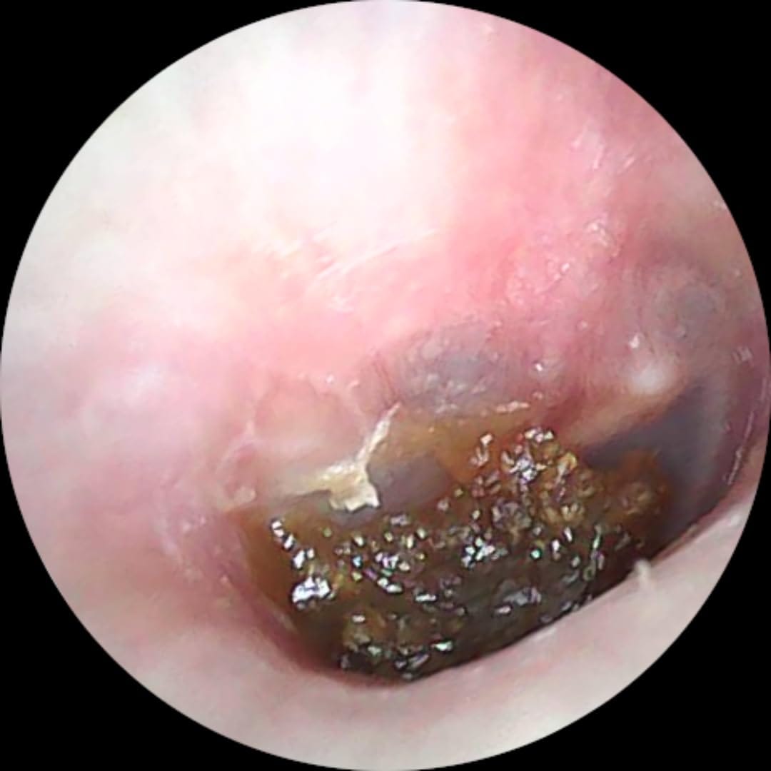 Customer photo review of Earclean - Doktor Onaylı 1080P Kulak Temizlik Kamerası