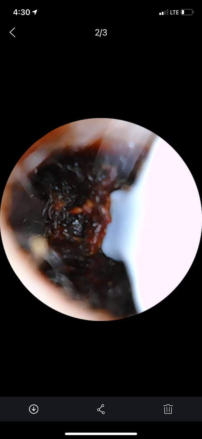 Customer photo review of Earclean - Doktor Onaylı 1080P Kulak Temizlik Kamerası