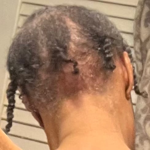 Close-up of a reviewer's scalp from the back, showing thin hair in small braids and areas of hair loss.