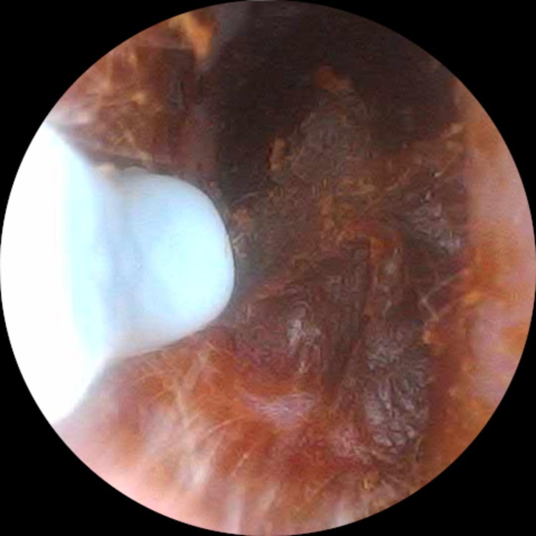 Customer photo review of Earclean - Doktor Onaylı 1080P Kulak Temizlik Kamerası