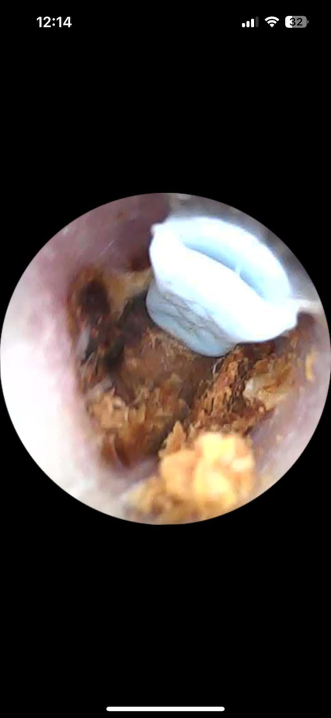 Customer photo review of Earclean - Doktor Onaylı 1080P Kulak Temizlik Kamerası