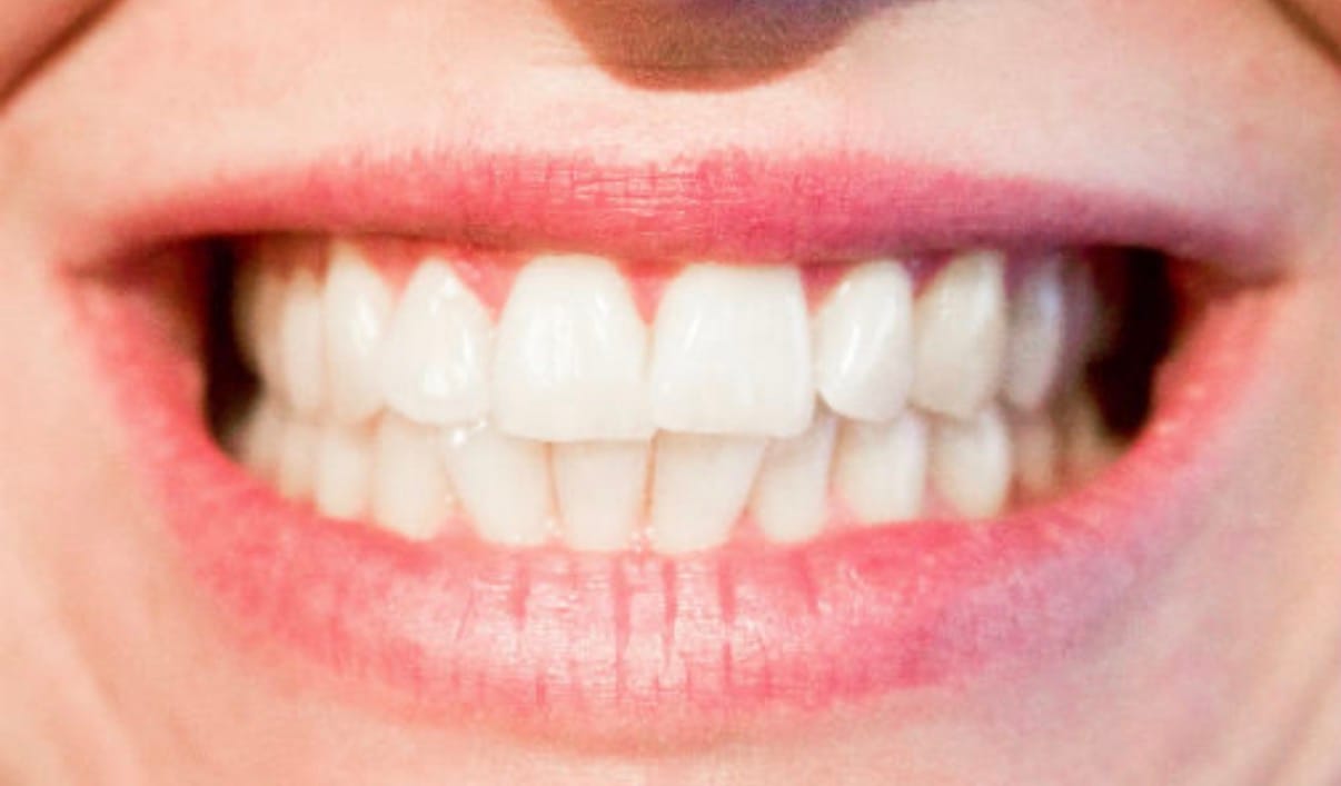 Customer photo review of Triple Pack : Bandes Kauka + Gel Violet + Bandes Violettes