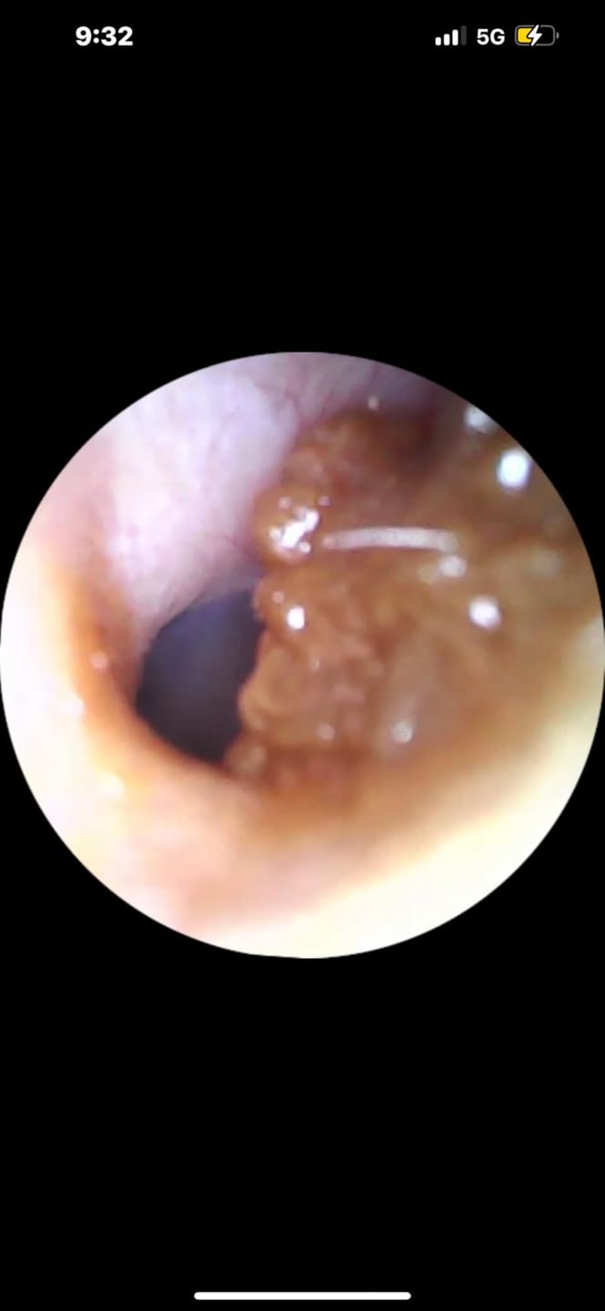 Customer photo review of Earclean - Doktor Onaylı 1080P Kulak Temizlik Kamerası