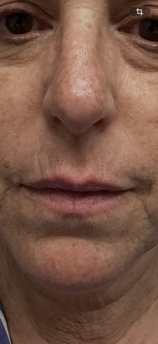 Close-up of a reviewer's mouth area showing lines around the lips before using the Seranova Micro Infusion System.