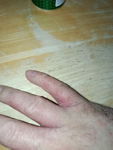 A vásárló keze a Sereni Krém használata előtt, piros, irritált bőrrel az ujjain.