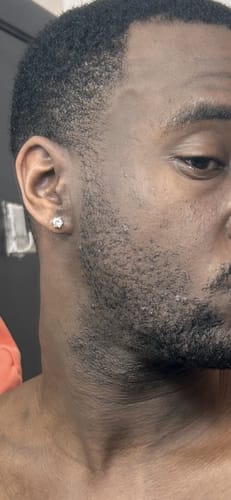 Close-up of a reviewer's cheek and neck, showing skin with bumps and some uneven texture.