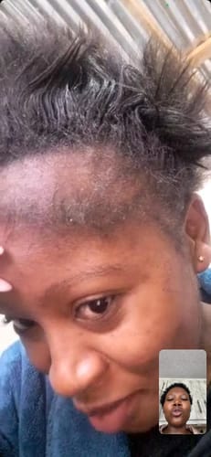 Customer photo review of Minoxidil 5% Solution, 1 Pack 60ml