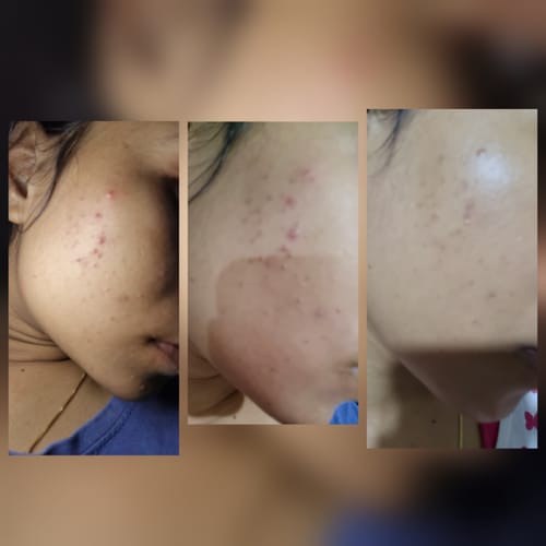 Customer photo review of salicylic acid serum with eraser 2x, To Reduce Acne, Pimples