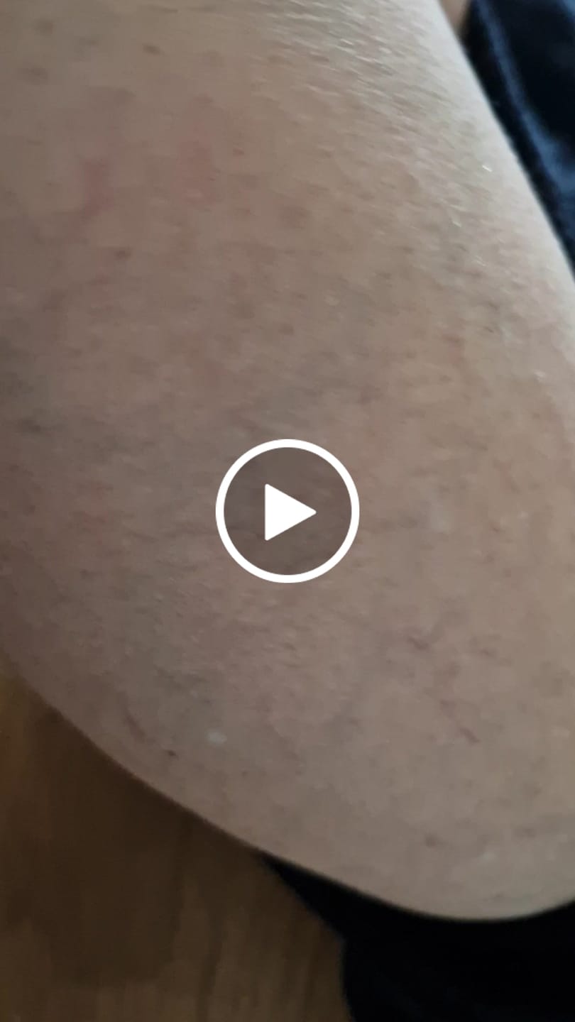 Customer video review of Crema Vene Varicose e Capillari