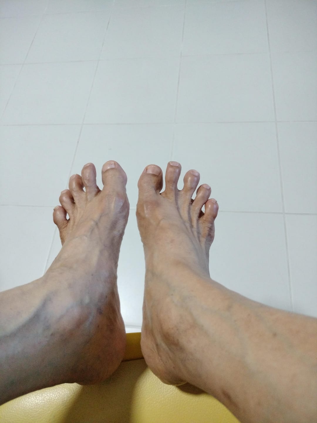 Customer photo review of Treatmedy™ Bunion Fix