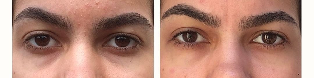 Customer photo review of Eye Roller | Eliminates Dark Circles & Puffy Eyes