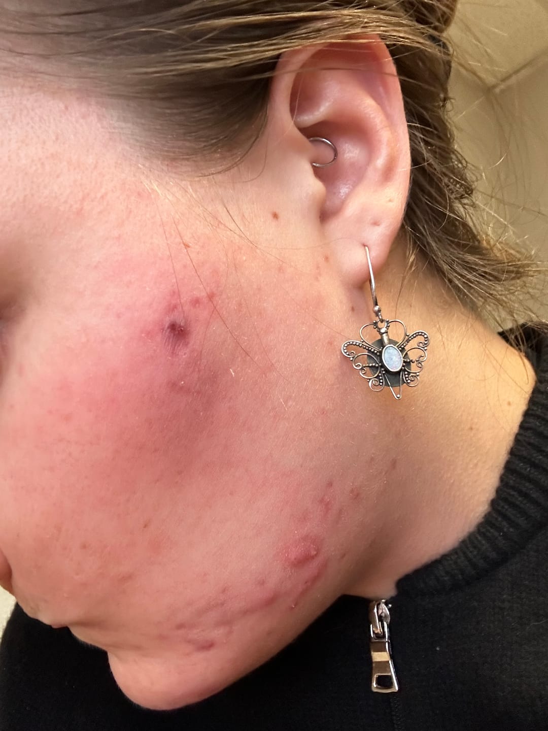 Customer photo review of Zilch Acne Formula