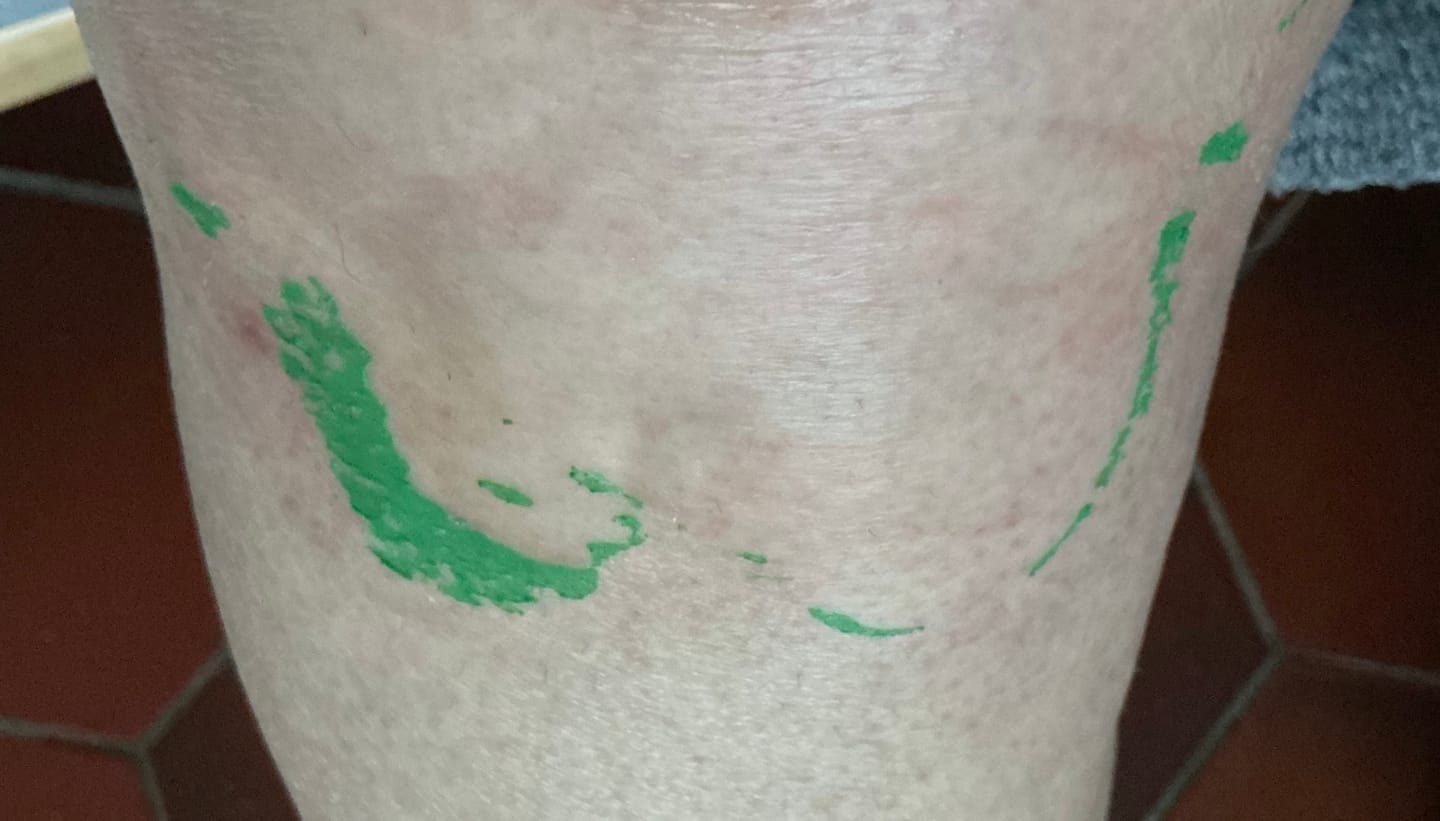 Customer photo review of Patchs anti-douleur
