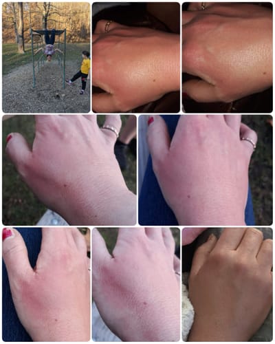 Customer's photo collage showing a hand's recovery, with swelling and redness visibly reduced after using the Qi Coil™ Mini System.
