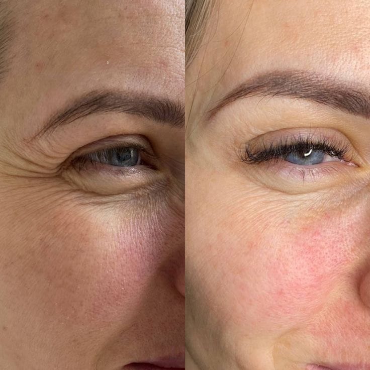 Customer photo review of PDRN Piel más firme y con menos lineas visible en 14 días — sin agujas
