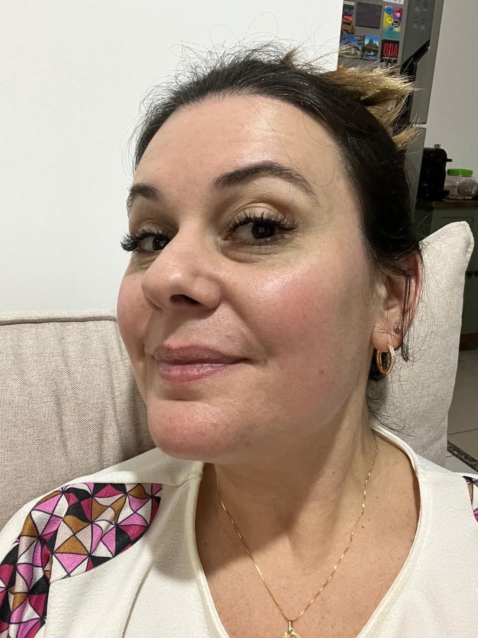 Customer photo review of PDRN Piel más firme y con menos lineas visible en 14 días — sin agujas