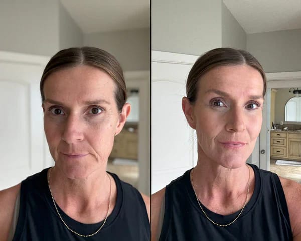 Customer photo review of PDRN Piel más firme y con menos lineas visible en 14 días — sin agujas